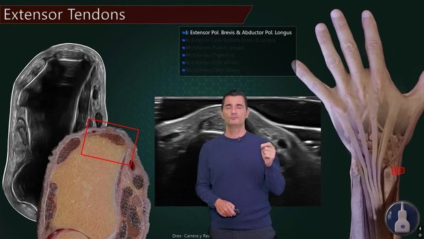 Extensor Tendons of the Wrist: Systematic Ultrasound Approach by ...