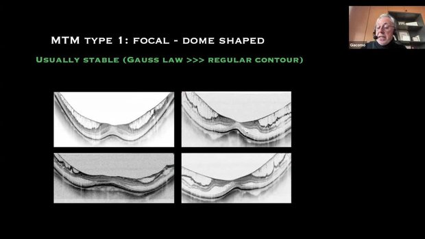 FLORetina-ICOOR 2025 Insights: Navigating Myopic Traction Maculopathy ...