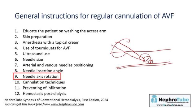 Understanding Vascular Access for Hemodialysis: AV Fistula vs AV Graft ...