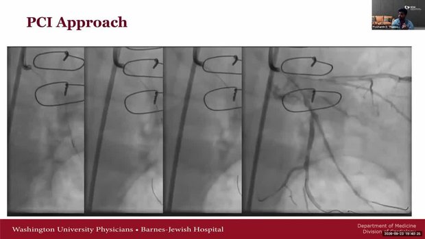 Cardiac Allograft Vasculopathy STEMI: Imaging-Guided PCI and IV P2Y12 ...