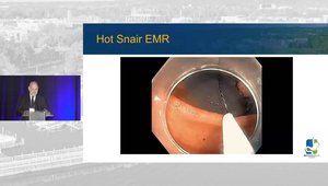 Hot vs. Cold Snare Polypectomy & Endoscopic Mucosal Resection | Vumedi