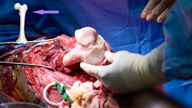 Conversion Distal Femur Replacement with Telescoping Tibial Allograft ...