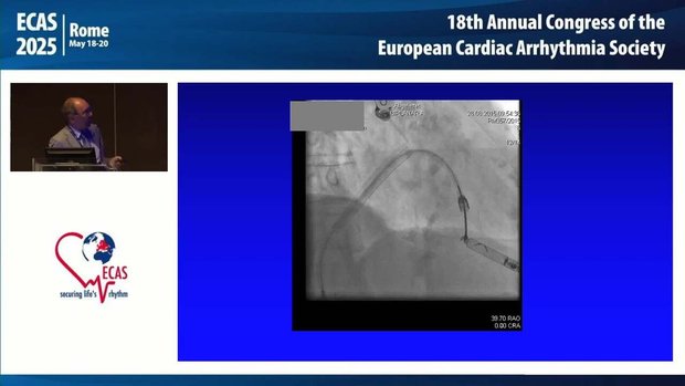 Leadless Pacing: Implantation and Explantation Experience | Vumedi