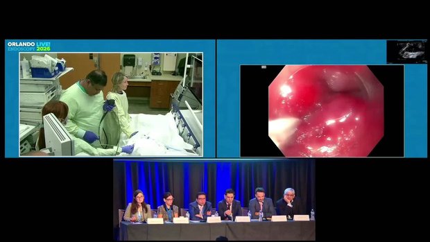 Live EGD with RFA & Cryoablation for Long Segment Barrett's Esophagus ...