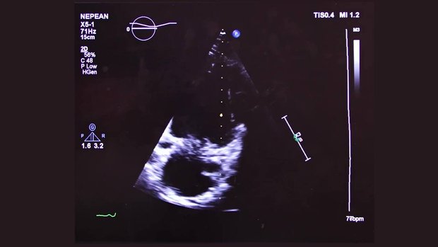 Transthoracic Echocardiogram Protocol: A Comprehensive Echo Study | Vumedi