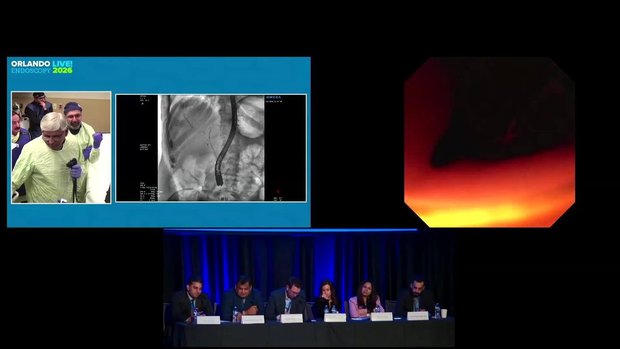 Live ERCP RFA for Patient with Tumor Invading Right and Left Hepatic ...