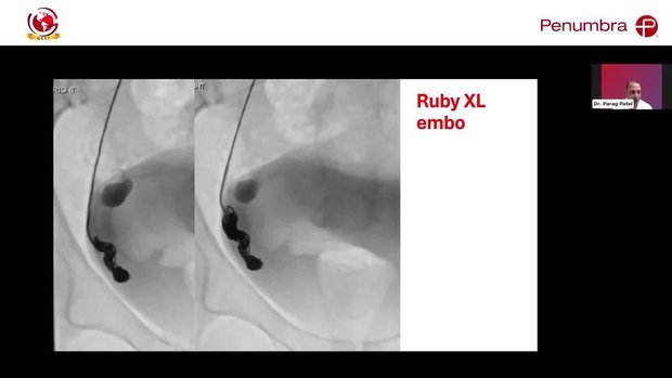 A New Class of Coils: The Ruby XL System | Vumedi