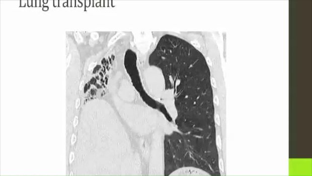 Update on the Diagnosis and Treatment of ILD | Vumedi