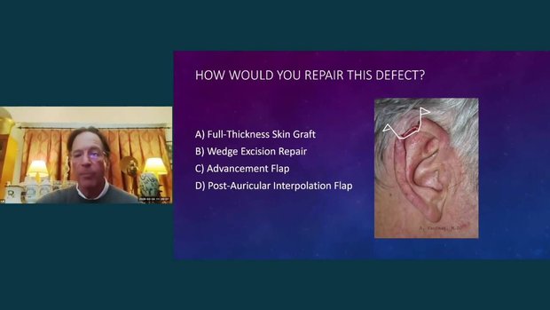 How Would You Fix This? Helical Rim Advancement Flap for Superior Ear ...