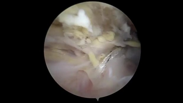 Knotless Speedbridge Technique for Rotator Cuff Repair with Self ...