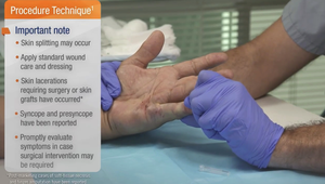 5th finger 30º MP and 50º PIP joint contractures: Treatment and ...