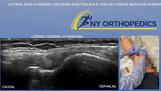 bpc 157 for it band syndrome Iliotibial Band Syndrome Cortisone Injection in a 31 Year Old Female  Marathon Runner