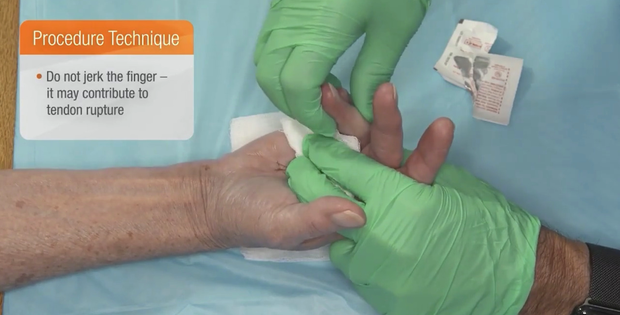 4th Finger 32º MP and 72º PIP joint contractures: Treatment and ...