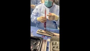 ACL Reconstruction Implant Preparation Using the AperFix System With ...