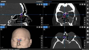 Frontal Sinus Anatomy Identification Utilizing Scopis Building Blocks ...