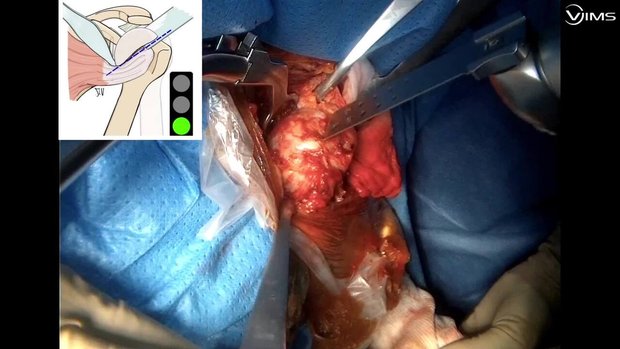 RSA Frankle Design and Subscapularis Sparing | Vumedi