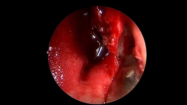 Maxillary Sinus Inverted Papilloma Resection Using the Endoscopic ...