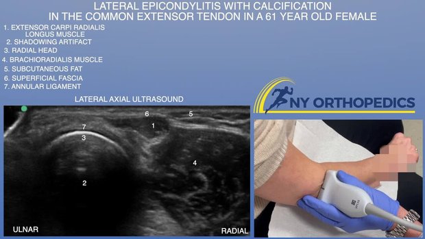 Lateral Epicondylitis With Calcification in the Common Extensor Tendon ...