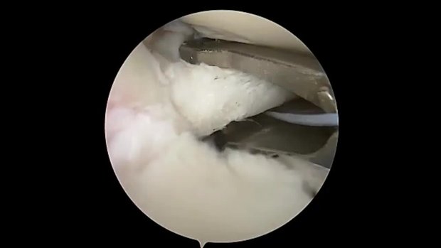 Lateral Meniscal Radial and Root Repair with Sutureloc and ACL ...