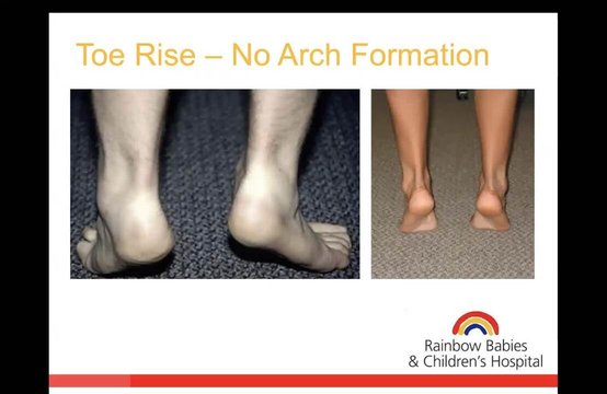 Pediatric Foot Deformity | Vumedi