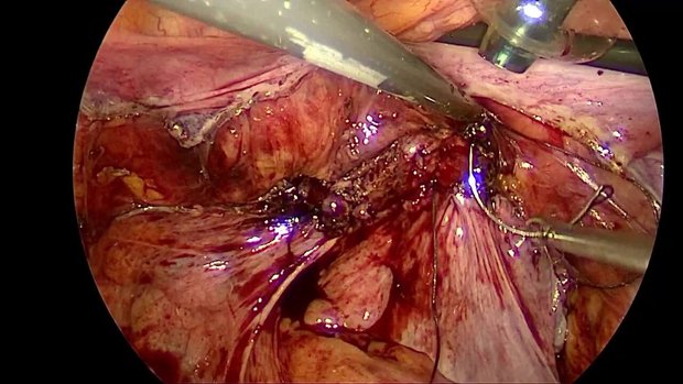 Laparoscopic Vaginal Cuff Closure: Vaginal Suturing Technique Following ...