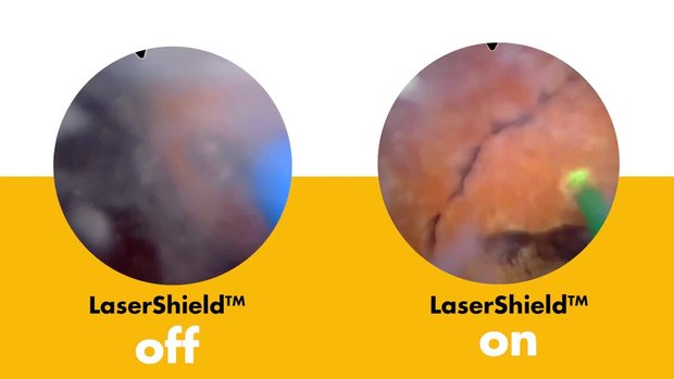 Cystolitholapaxy with LaserShield technology | Vumedi