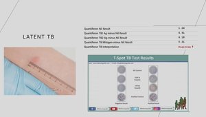 TB and LTBI in Primary Care | Vumedi
