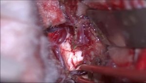 Resecting Right Frontal AVM With a Bifrontal Approach | Vumedi
