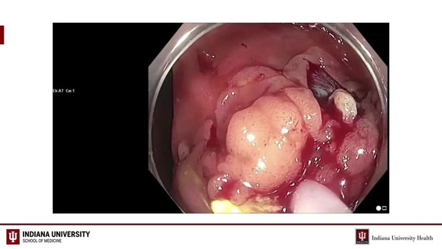 Endoscopic Management of Complex Polyps | Vumedi