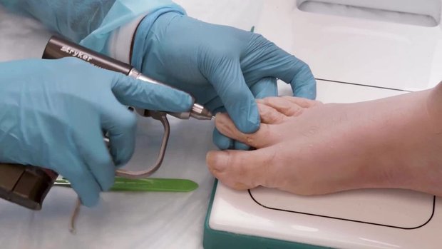 Minimally Invasive Hammer Toe Correction | Vumedi