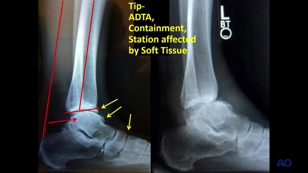 Pilon Fractures: Lessons Learned Through Failure | Vumedi