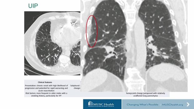 Interstitial Lung Disease Imaging: What Is the Role of Pattern ...