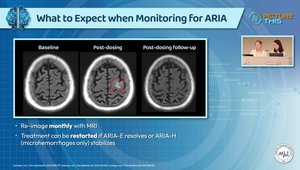 ARIA Imaging CME: Detecting Amyloid Abnormalities in Alzheimer's ...