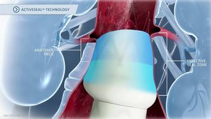 AFX2 Endovascular AAA System: Fundamentally different from all other ...