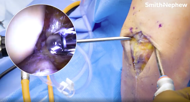 BTB ACL Reconstruction using adjustable suspensory fixation with ...
