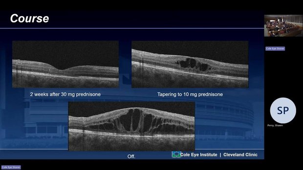 Intermediate Uveitis in Adolescents: Managing CME, Vasculitis, and ...