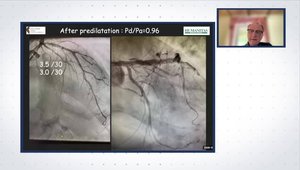 Coronary Bifurcation Disease: Integrating DCBs With DES to Simplify ...
