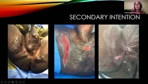 Surgical Management of Hidradenitis Suppurativa: Debridement, Excision ...