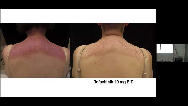 More Than Skin Deep: Diagnostic and Therapeutic Challenges in Autoimmune  Disease