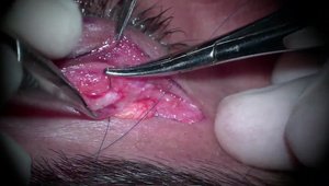 Levator Palpebrae Superioris (LPS) Resection for Congenital Ptosis ...