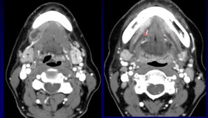 Ranula Mimics in the Submandibular Space: Distinguishing Plunging ...