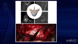 The Mini-Open Lateral Retropleural Approach | Vumedi