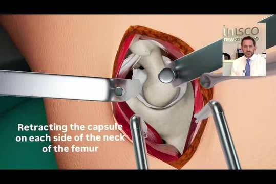 SuperPATH Arthroplasty: The Most Modern Hip Approach - Educational ...
