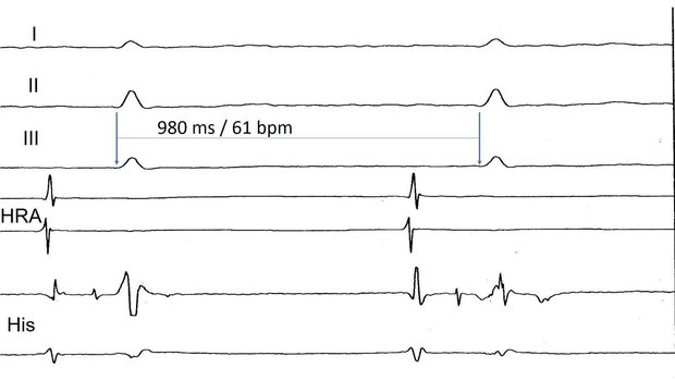 European Cardiac Arrhythmia Society (ECAS) | Vumedi