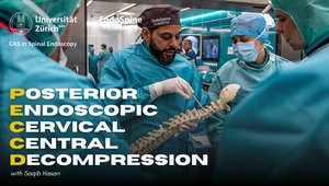 How to Perform a Posterior Endoscopic Cervical Central Decompression ...