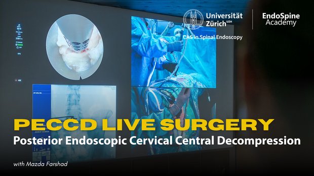 Posterior Endoscopic Cervical Central Decompression (PECCD) | Vumedi