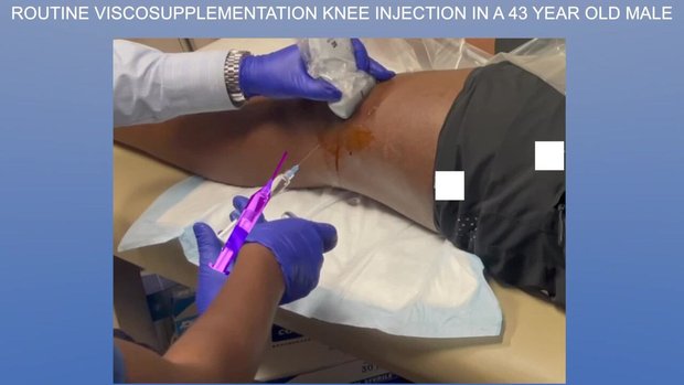 Routine Viscosupplementation Knee Injection in a 43 Year Old Male | Vumedi