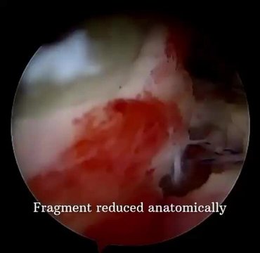 Arthroscopic Anterior Glenoid Rim Fracture Fixation with Tensionable ...
