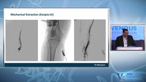 Mechanical Thrombectomy for Deep Vein Thrombosis and Pulmonary Embolism ...