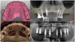 Dynamic Surgical Navigation: Digital Workflow for Full Mouth Rehabilitation